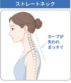 ストレートネックで頭が前に出た状態のイラスト